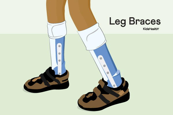 Leg Braces (Orthoses)