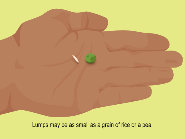 Tell your doctor right away if you notice any swelling, lumps, or changes in the size or color of a testicle. Also tell your doctor if you have any pain or achy areas in your groin.

Lumps or swelling may not be cancer, but they should be checked by your doctor as soon as possible.

Testicular cancer is almost always curable if it is caught and treated early.