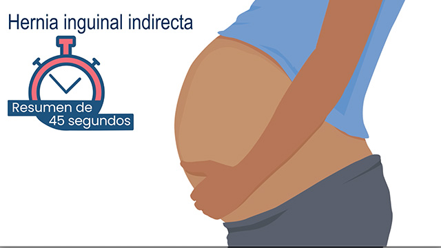 Resumen de 45 segundos: Hernia inguinal indirecta