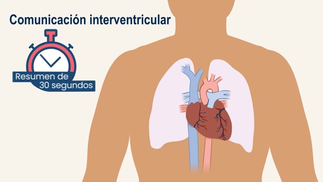 Resumen de 30 segundos: Comunicación interventricular