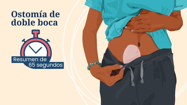 Resumen de 65 segundos: Ostomía de doble boca