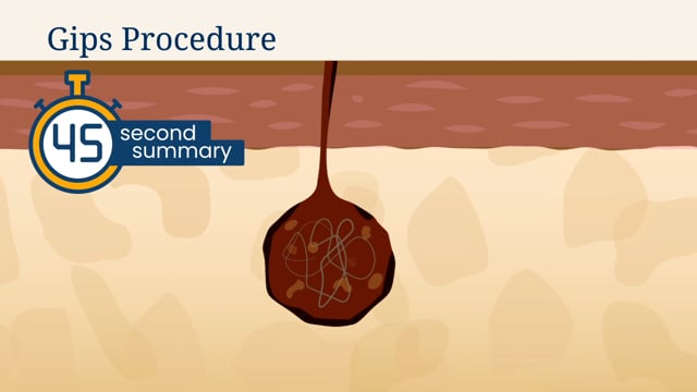 45-Second Summary: Gips Procedure