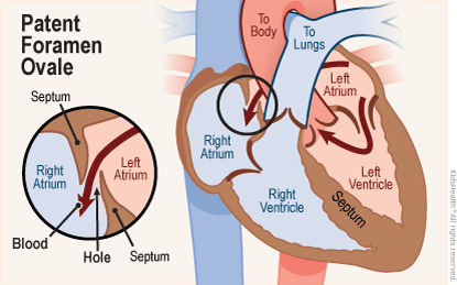 Two close-up diagrams (one a super close-up) show a patent foramen ovale —  where blood continues to flow from the left atrium into the right atrium through a hole in the septum which normally closes after birth.