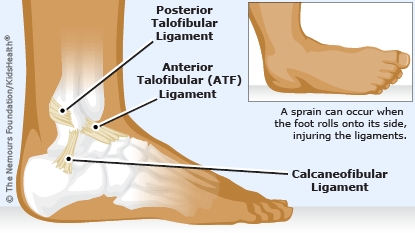 sprained right ankle illustration