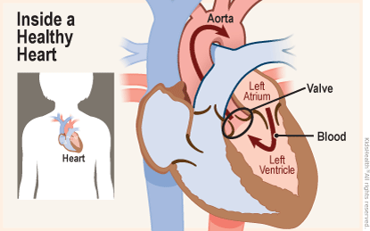 Two diagrams show the position of the heart in the body and a close-up, cross section of a healthy heart. Blood flows from the left atrium into the left ventricle and through a valve into the aorta. 