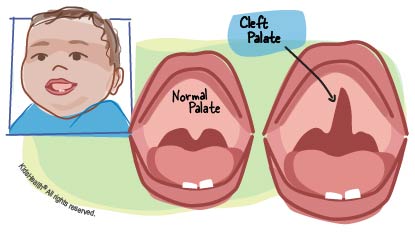 Cleft Palate