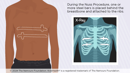 Two views of boy's chest showing where steel bars are placed.