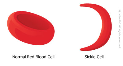 sickle cell