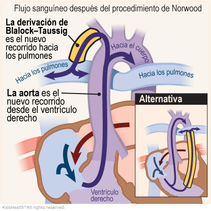 Illustration: After the Norwood procedure, blood reaches the lungs through the shunt.