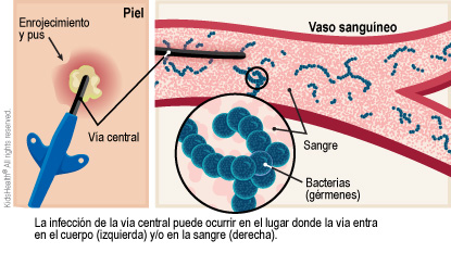 Se muestra la infección de la vía central que puede ocurrir en el lugar donde la vía entra en el cuerpo a través de la piel causando enrojecimiento y pus, y/o en la sangre, causando bacterias (gérmenes) dentro del vaso sanguíneo.