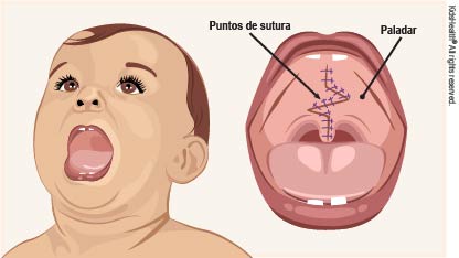 100211_cleftpalate_rd4