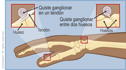 Illustration: Ganglion Cyst