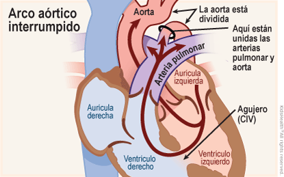 Se muestra un corte transversal del corazón con un arco aórtico interrumpido: un defecto congénito donde se divide la aorta, la parte superior es normal, pero debajo se unen la aorta y la arteria pulmonar.  Un poco de sangre fluye normalmente de la aurícula izquierda al ventrículo izquierdo para luego dirigirse hacia la aorta.  Pero un orificio en el tabique que separa los dos ventrículos permite que la sangre fluya directamente del ventrículo izquierdo al derecho.