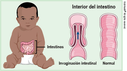 Invaginacion intestinal