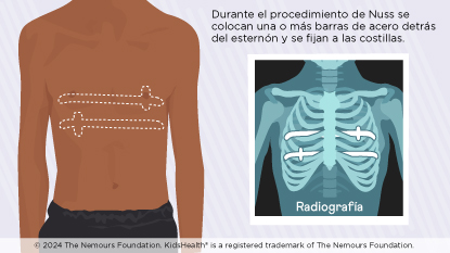Dos vistas del tórax del niño que muestran dónde se colocan las barras de acero.