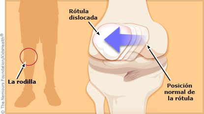 Se muestra cómo la rótula pasa de estar en su posición normal a estar dislocada.