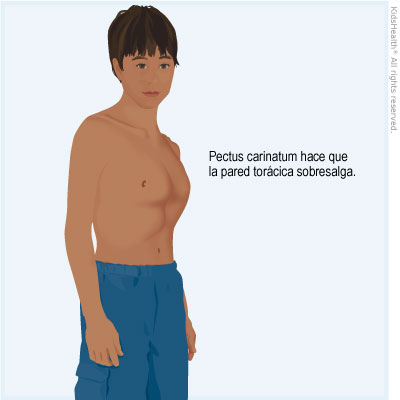 El pectus carinatum hace que el pecho sobresalga.