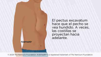 El pectus excavatum provoca un hundimiento del tórax. A veces las costillas pueden ensancharse.