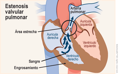 Se muestra un corte transversal de un corazón con estenosis valvular pulmonar, donde la válvula entre el ventrículo derecho y la arteria pulmonar es demasiado estrecha y restringe el flujo sanguíneo.  En algunos casos, esta afección produce un engrosamiento de los músculos del ventrículo.