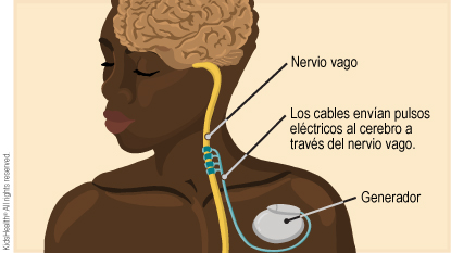 En el interior del tórax, los cables salen de un generador y se dirigen al nervio vago. Los cables envían pulsos eléctricos al cerebro a través del nervio vago.